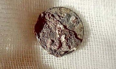 Ad un uomo rimossa dopo 53 anni una moneta nel naso.