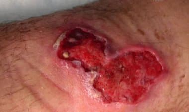 Virus "mangia carne" si diffonde in Australia: lo portano le zanzare