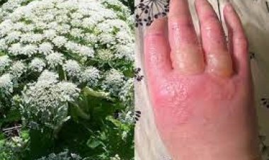 Panace gigante, la pianta che causa ustioni si sta diffondendo rapidamente in Italia